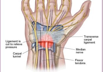 Massage Can Be a Light at the End of the Carpal Tunnel (video included)